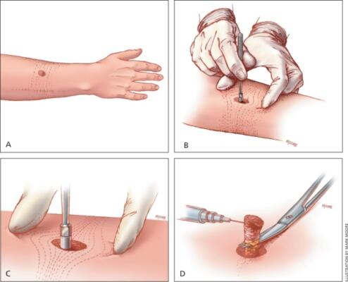 biopsy