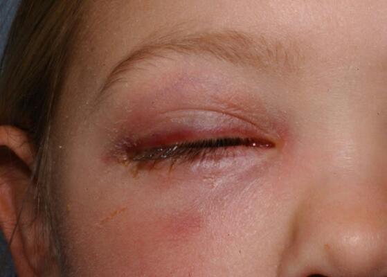 cellulitis