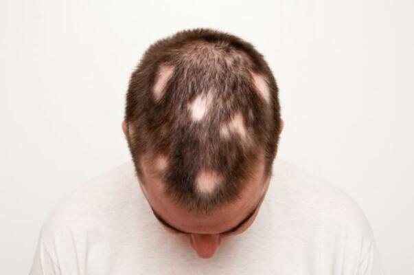 circular bald shapes