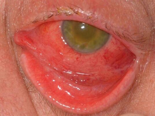 endopthalmolitis