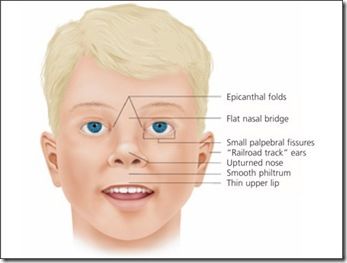 fetal alcohol syndrome
