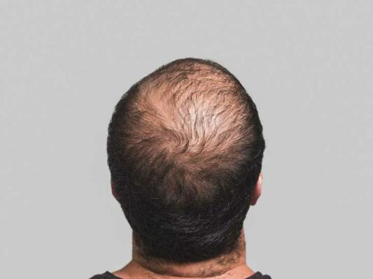 bald man