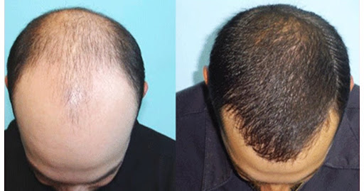 hair growth