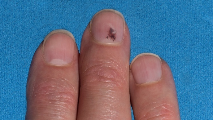 melanoma under nail