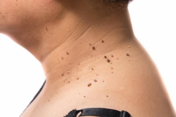 mole