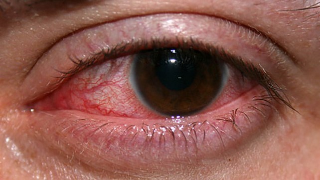 red eye